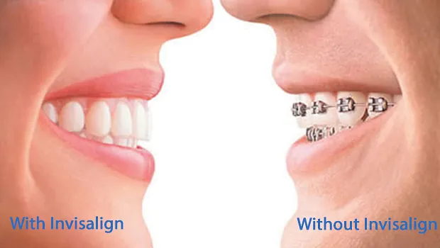 Demonstrating how Invisalign works